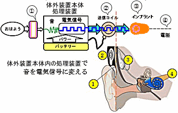 マイクで音を拾って、体外装置内の処理装置で音を電気信号に換えます。送信コイルを使って電気信号をインプラントの電極で蝸牛を刺激する様子を表しています。